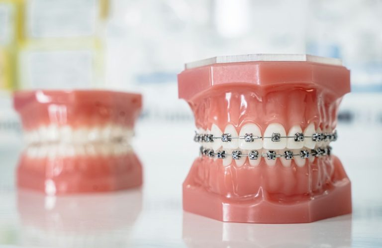 Kieferorthopädie Zwei kieferorthopädische Modelle mit Brackets und Zähnen auf einem Tisch.